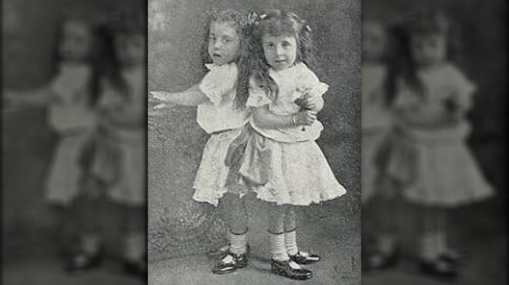 The Astonishing Story Of The Conjoined Hilton Twins